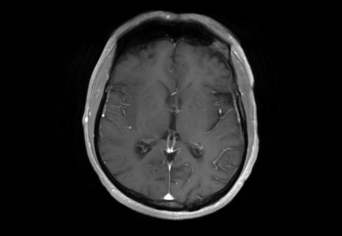 Bildgebung - cMRT nummeriert