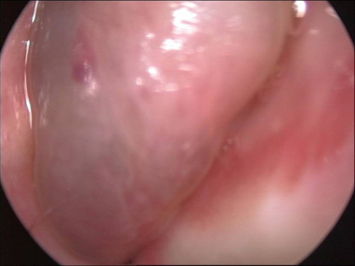 Makroskopie - Nasenendoskopie