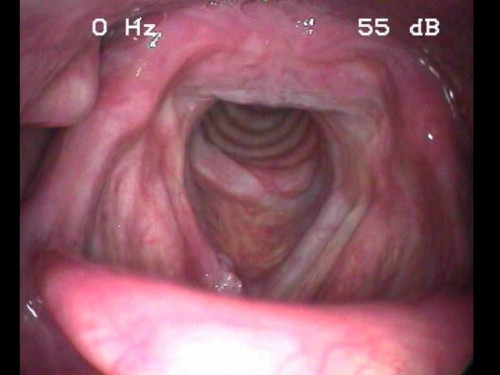 Makroskopie - Lupenlaryngoskopie (90° Optik)