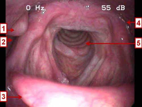 Makroskopie - Lupenlaryngoskopie (90° Optik) nummeriert