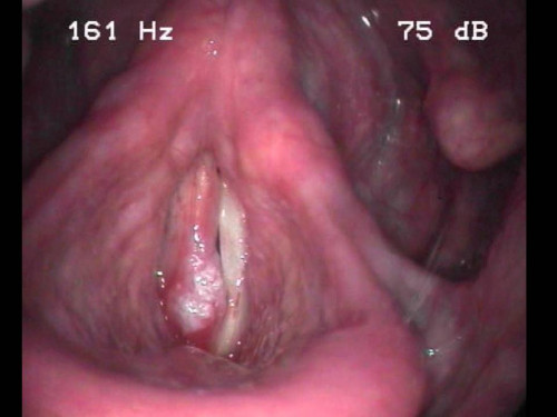 Makroskopie - Lupenlaryngoskopie (90° Optik)