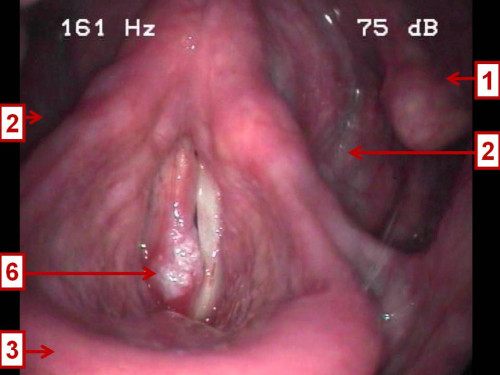 Makroskopie - Lupenlaryngoskopie (90° Optik) nummeriert