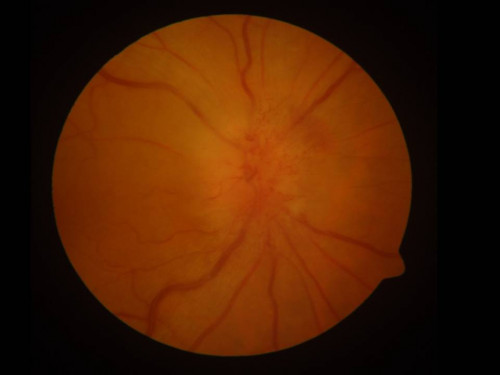 Funduskopie - Auge rechts