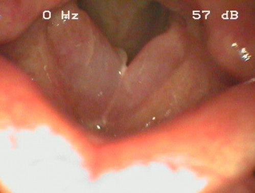 Makroskopie - Lupenlaryngoskopie (90° Optik) Respiration