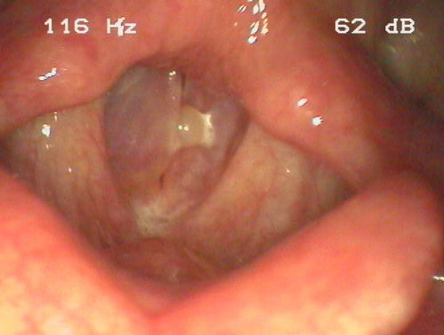 Makroskopie - Lupenlaryngoskopie (90° Optik) Phonation