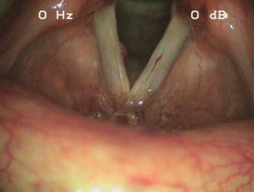Makroskopie - Lupenlaryngoskopie (90° Optik) Respiration