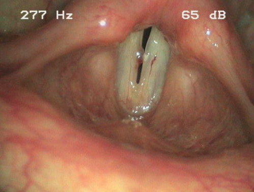 Makroskopie - Lupenlaryngoskopie (90° Optik) Phonation