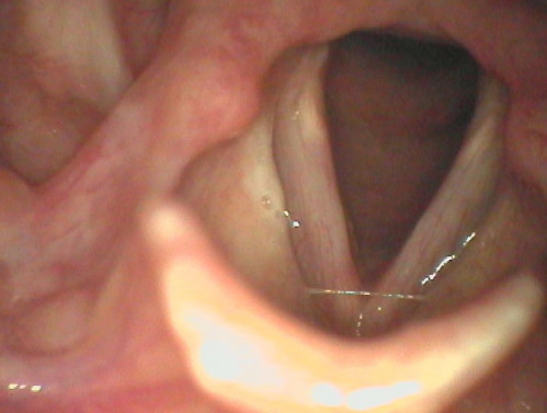 Makroskopie - Lupenlaryngoskopie (90° Optik) Respiration
