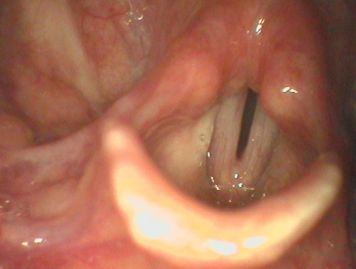 Makroskopie - Lupenlaryngoskopie (90° Optik) Phonation