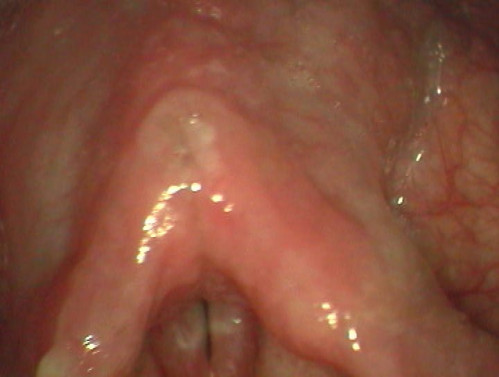 Makroskopie - Untersuchung Phonation