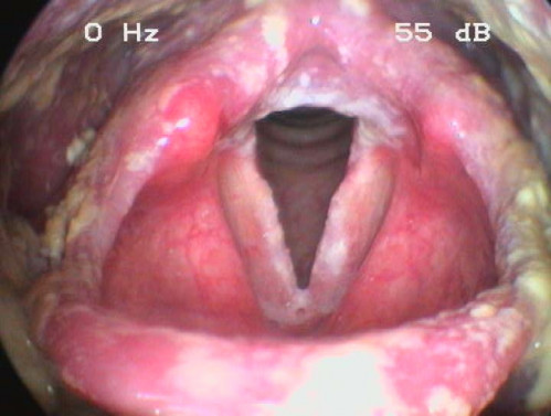 Makroskopie - Lupenlaryngoskopie (90° Optik) Respiration