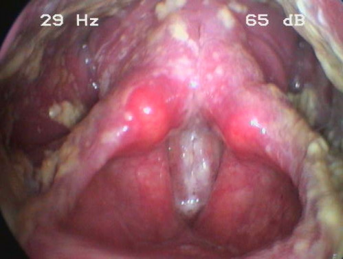 Makroskopie - Lupenlaryngoskopie (90° Optik) Phonation