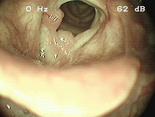 Makroskopie - Lupenlaryngoskopie (90° Optik) Respiration