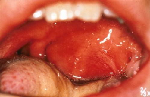 Makroskopie - Untersuchung des Oropharynx