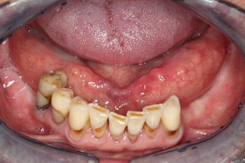 Makroskopie - intraoral präoperativ