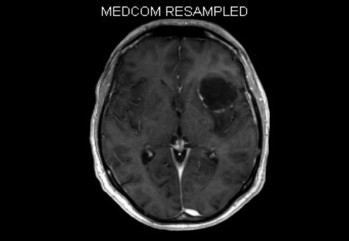 Bildgebung - MRT (T1 + Gadolinium)