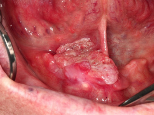 Makroskopie - präoperativ intraoral
