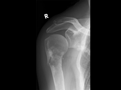 Bildgebung - Röntgen Schulter a.p. präoperativ