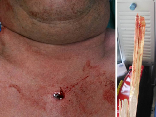 Makroskopie - Verletzung und Gegenstand