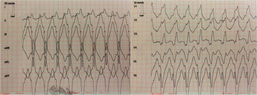 Elektrokardiogramm - 12-Kanal-EKG