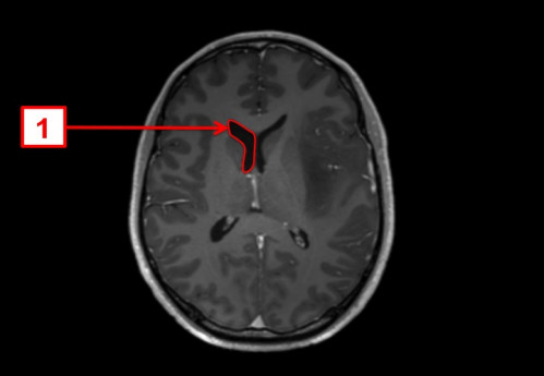 Bildgebung - MRT axial (T1-Wichtung nach Kontrastmittelgabe und FLAIR-Wichtung) nummeriert