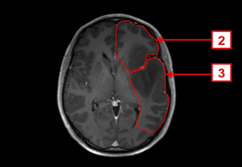 Bildgebung - MRT axial (T1-Wichtung nach Kontrastmittelgabe und FLAIR-Wichtung) nummeriert