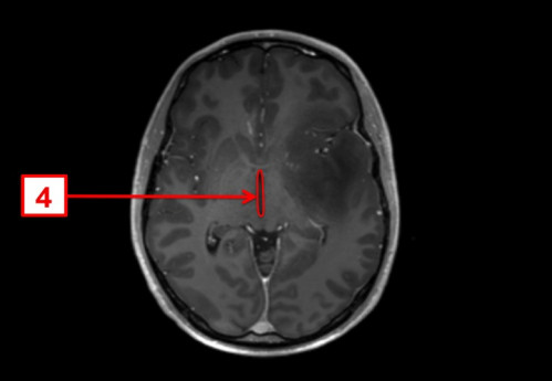 Bildgebung - MRT axial (T1-Wichtung nach Kontrastmittelgabe und FLAIR-Wichtung) nummeriert