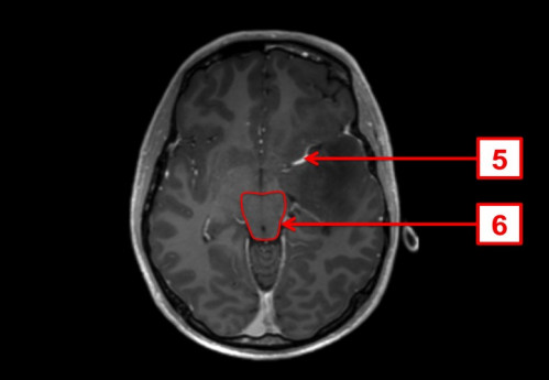 Bildgebung - MRT axial (T1-Wichtung nach Kontrastmittelgabe und FLAIR-Wichtung) nummeriert
