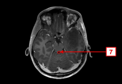 Bildgebung - MRT axial (T1-Wichtung nach Kontrastmittelgabe und FLAIR-Wichtung) nummeriert