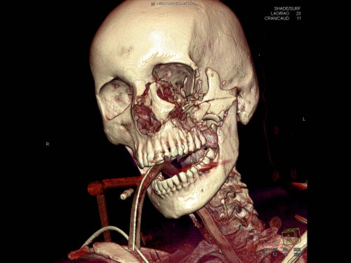 Bildgebung - 3D CT präoperativ