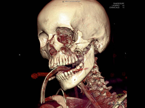 Bildgebung - 3D CT präoperativ