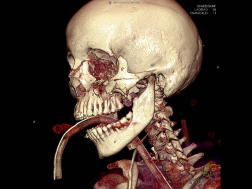Bildgebung - 3D CT präoperativ