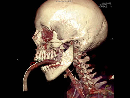 Bildgebung - 3D CT präoperativ
