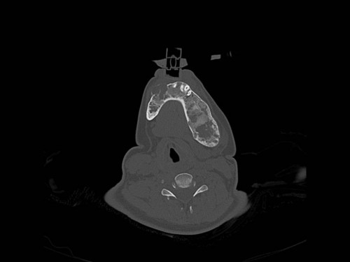 Bildgebung - CT axial präoperativ