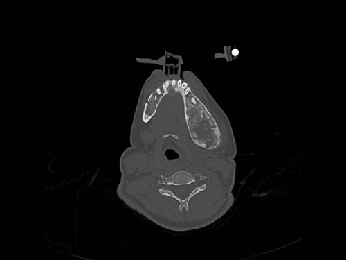 Bildgebung - CT axial präoperativ