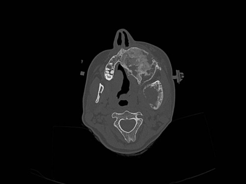 Bildgebung - CT axial präoperativ