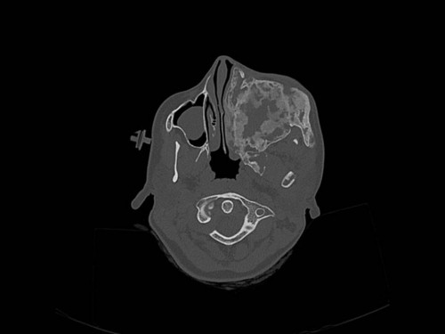 Bildgebung - CT axial präoperativ
