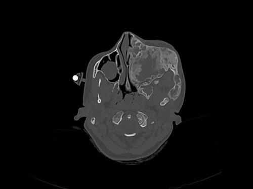 Bildgebung - CT axial präoperativ