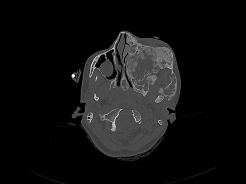 Bildgebung - CT axial präoperativ