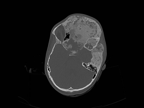 Bildgebung - CT axial präoperativ