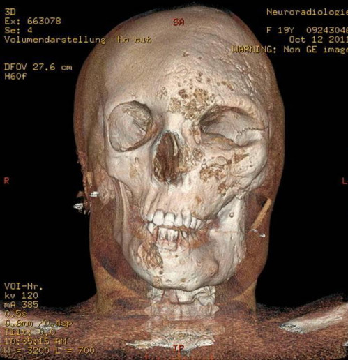 Bildgebung - 3D CT präoperativ