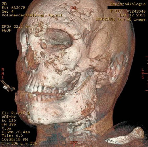 Bildgebung - 3D CT präoperativ