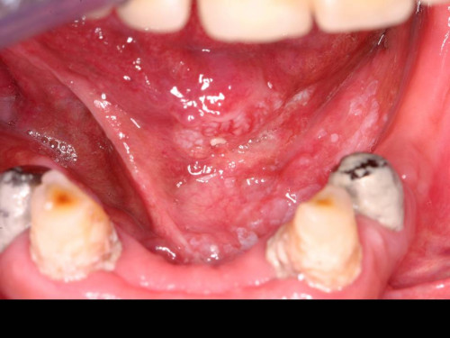 Makroskopie - intraoral präoperativ