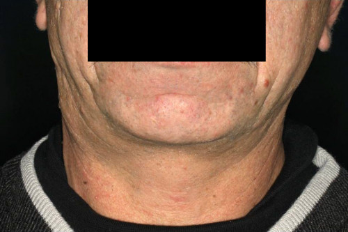 Makroskopie - exoral präoperativ