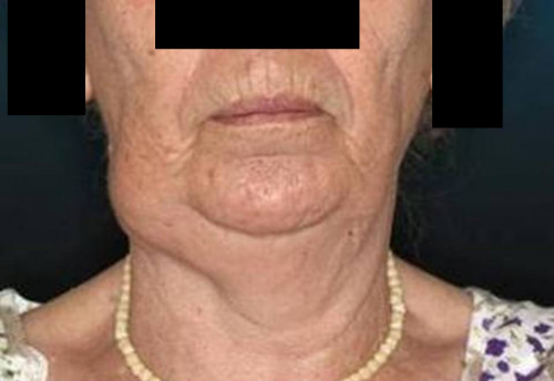 Makroskopie - Porträt frontal präoperativ