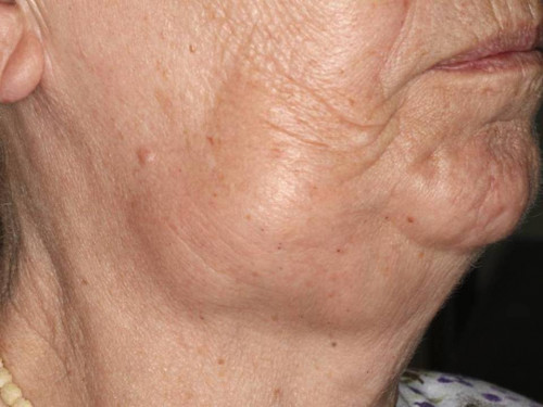 Makroskopie - Porträt seitlich präoperativ