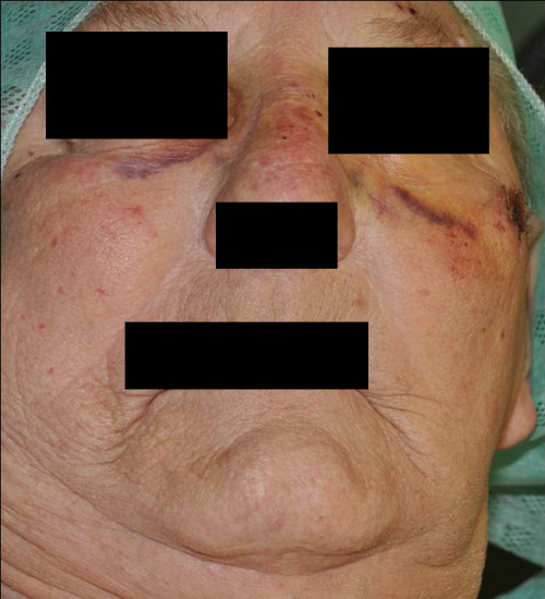 Makroskopie - präoperativ