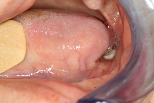 Makroskopie - intraoral präoperativ