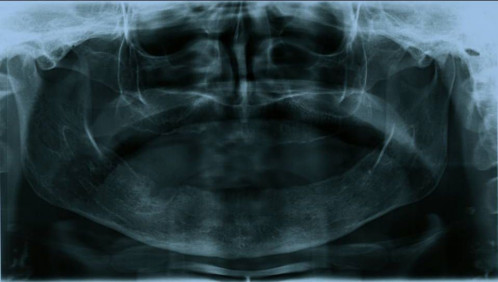 Bildgebung - OPAN präoperativ