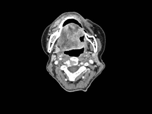 Bildgebung präoperativ - CT